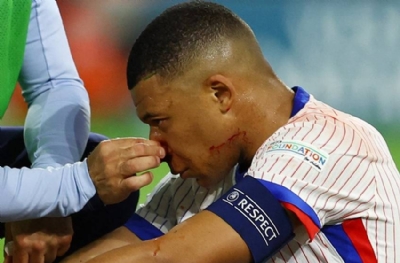 Mbappe'nin burnu kırıldı